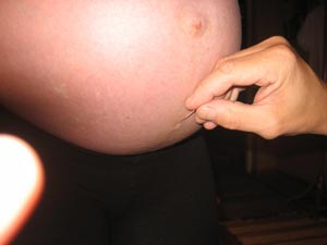 Akupunkturbehandling för att lindra smärta av gravid mage